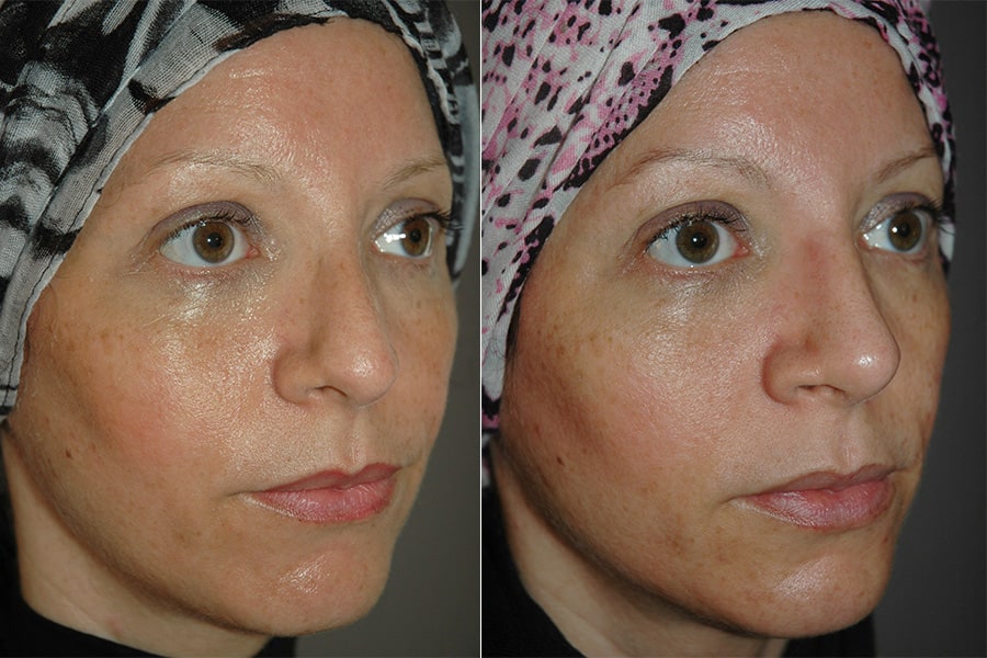 rhinoplastie standard realignement 2 chirurgie nez dr frederic sauveur sarfati chirurgien esthetique plasticien paris